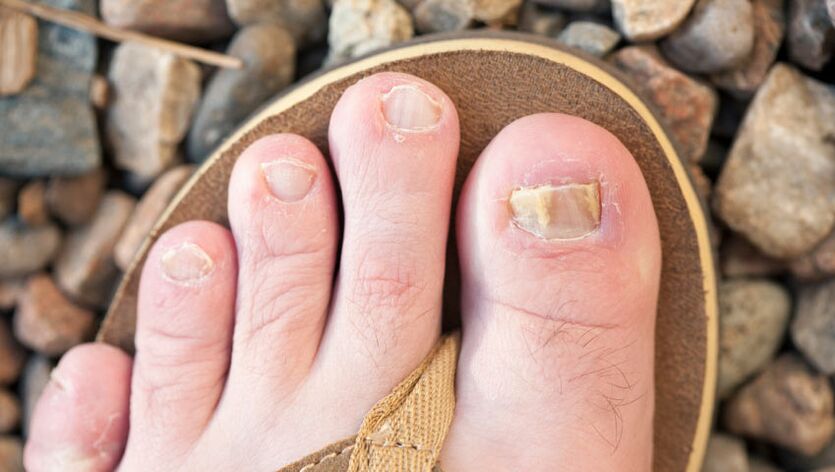 Nagu onychomycosis